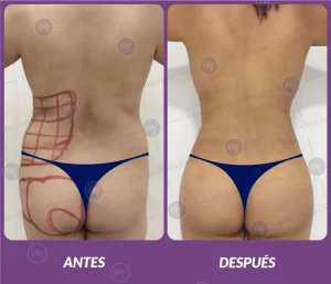 Lipotransferencia 4